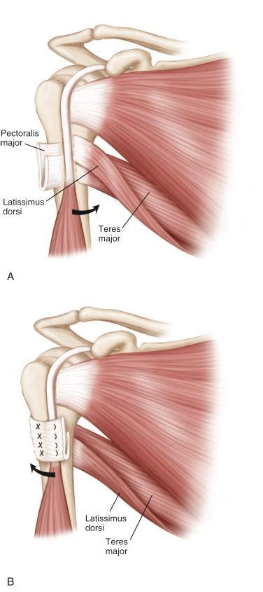 Tendon Transfers With A Reverse Arthroplasty When And How Clinical Tree