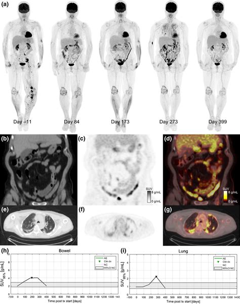 A 68 Year Old Patient With Metastatic BRAF Wild Type Melanoma Who Was