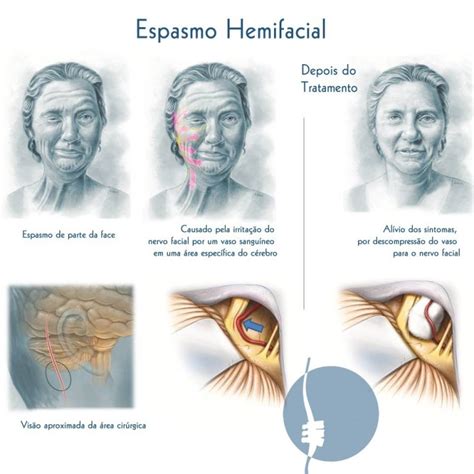 Espasmo Hemifacial Cl Nica Da Coluna Dr Fernando Schmidt E Dr