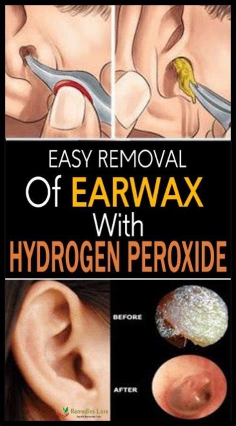 Easy Removal Of Earwax With Hydrogen Peroxide Asezeeffsite Ear Wax Ear Wax Removal