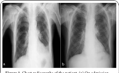 Figure 1 From Vertebral Tuberculosis Presenting As A Posterior Mediastinal Mass Semantic Scholar