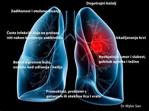 Rak Plu A Nove Mogu Nosti Lije Enja Dr Myko San