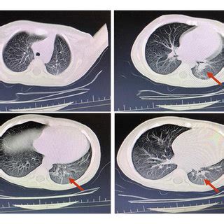 Spiral CT scan of chest without contrast. | Download Scientific Diagram