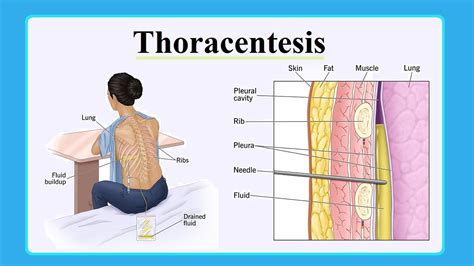 thoracentesis - YouTube