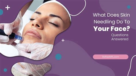 What Does Skin Needling Do For Your Face Ultimate Guide Refresh