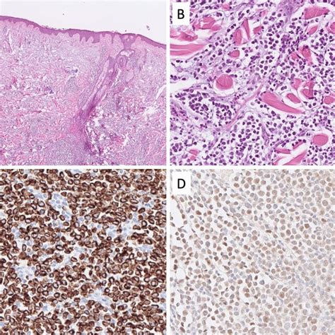 Differential Diagnosis Of A Neuroendocrine Carcinoma Merkel Cell