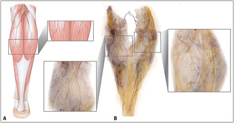 Intramuscular Neural Distribution Of The Gastrocnemius For Botulinum