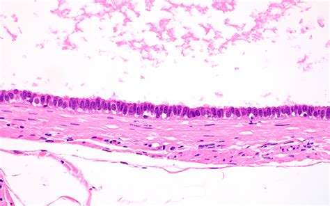 Pathology Outlines - Paratubal cysts