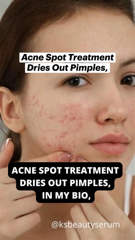 How To Treat Each Type Of All Acne Artofit