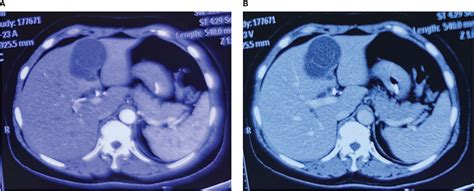 Frontiers Case Report Obstructive Jaundice Caused By Biliary Cystadenoma