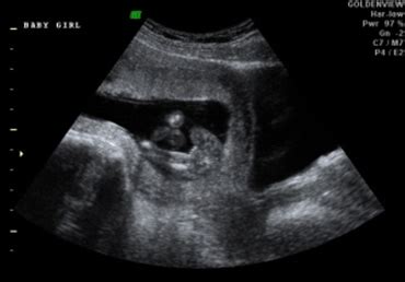 Gender Reveal Ultrasound Services - Goldenview Ultrasound