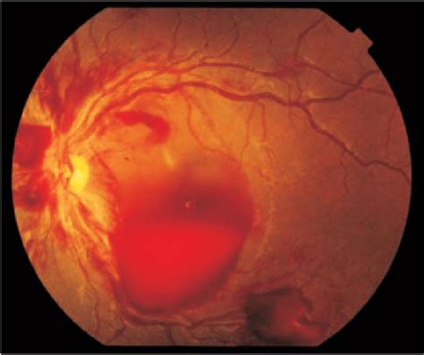 Fundus Photograph Of Left Eye Showing A Large Pre Retinal Haemorrhage