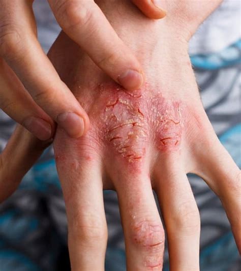 Eczema Know About Disease Treatments And Cost Skinaa Clinic Jagatpura