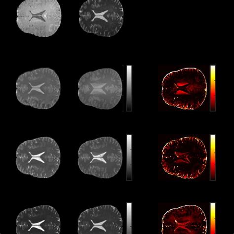 A Representative Axial Slice Of T1 T2 And Pd Maps Synthesized From The