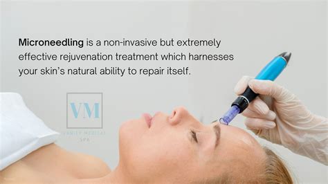 Everything You Need To Know About Microneedling Before Trying It