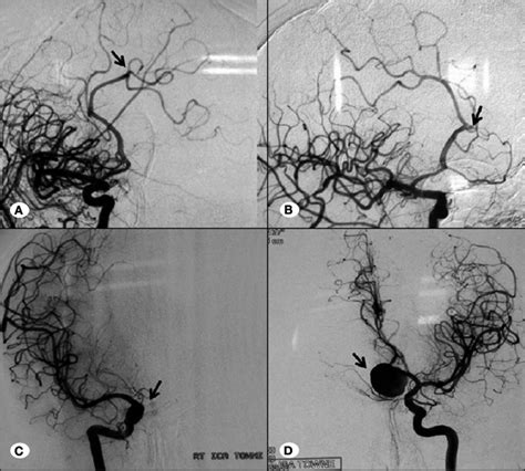 Dsa Examination Showing Examples Of Acs Variations A Pericallosal