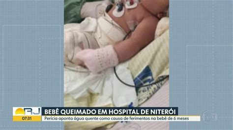 Beb Internada Sofreu Queimaduras Em Do Corpo Diretora Do Hospital