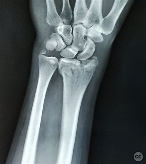 Percutaneous K Wire Fixation Of An Intraarticular Distal Radius Fracture