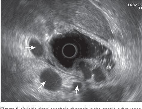 Figure 2 From Endoscopic Ultrasound Eus For Esophageal And Gastric