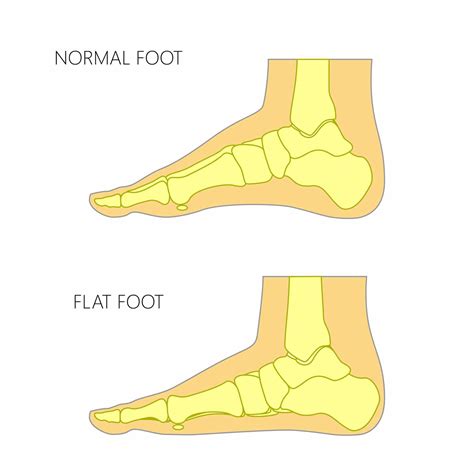 flat feet  children        worried