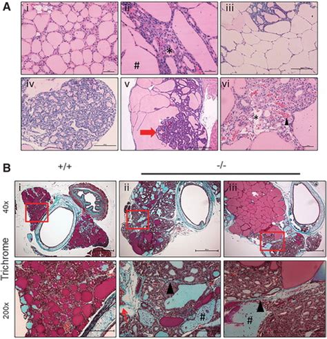 Multinodular Goiter Histology