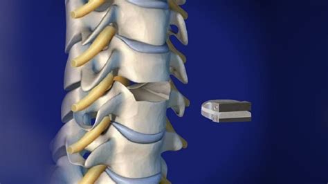 Spine Surgeon in Patna | Lumber Disc Replacement | Cervical Disc