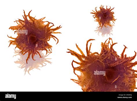 Tumour Hi Res Stock Photography And Images Alamy