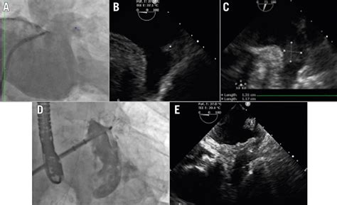 Percutaneous Left Atrial Appendage Closure Beyond The Classic