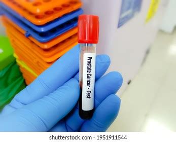 Blood Sample Psa Prostatespecific Antigen Test Stock Photo