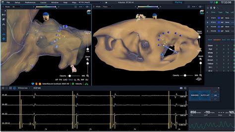 The Kodex Epd Mapping System Showed Three Dimensional Anatomical Image Download Scientific