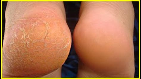 In Night Get Rid Of Cracks Get Smooth Beautiful Feet Home Remedy