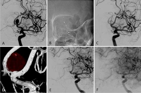 The Luna Aneurysm Embolization System For Intracranial Aneurysm