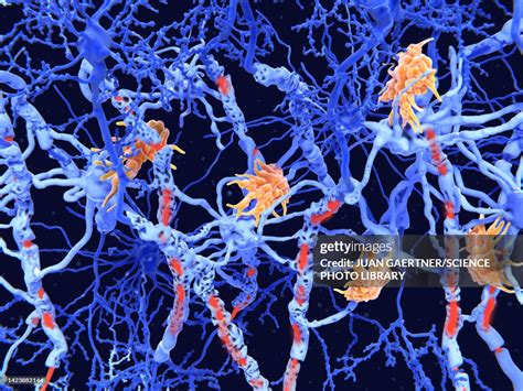 Nerve Damage In Multiple Sclerosis Illustration High-Res Vector Graphic ...