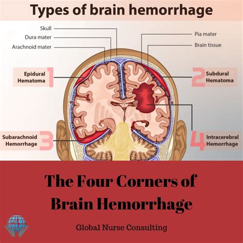 The Four Corners Of Brain Hemorrhage