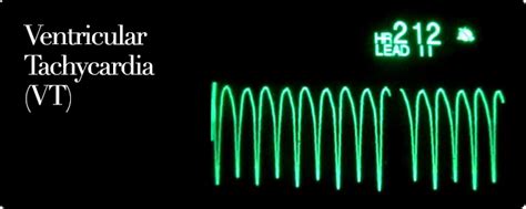 Ventricular Tachycardia (VT) | Ruth Kam Heart & Arrhythmia Clinic