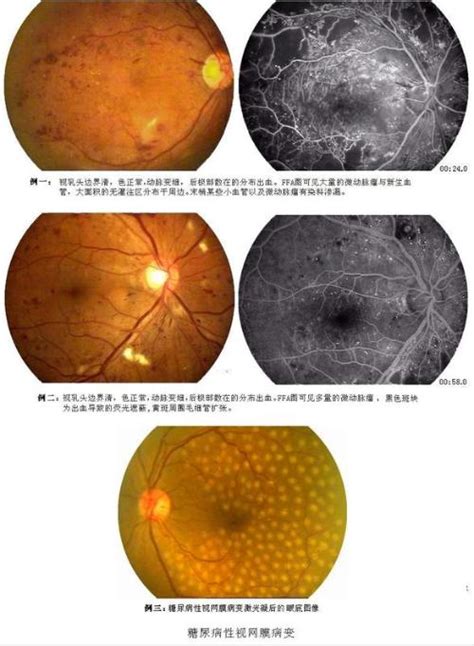 糖尿病性视网膜病变 搜狗百科