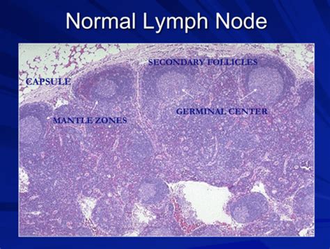 Lecture 12 Non Hodgkins Lymphoma Flashcards Quizlet