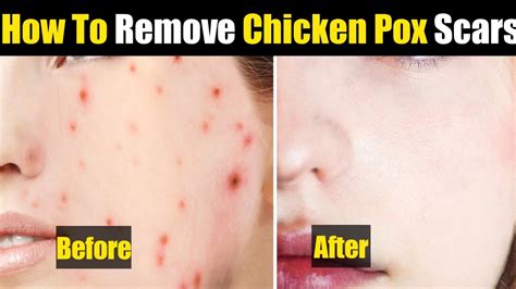 Chicken Pox Ke Daag Kaise Thik Kare How To Remove Chicken Pox Spot At