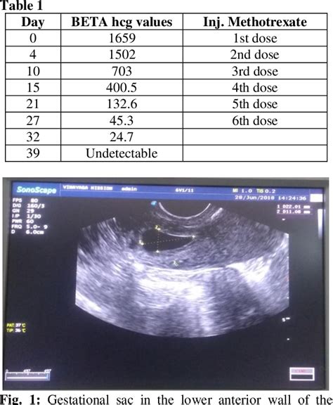 Table 1 From A Success Of Cesarean Scar Ectopic Pregnancy By