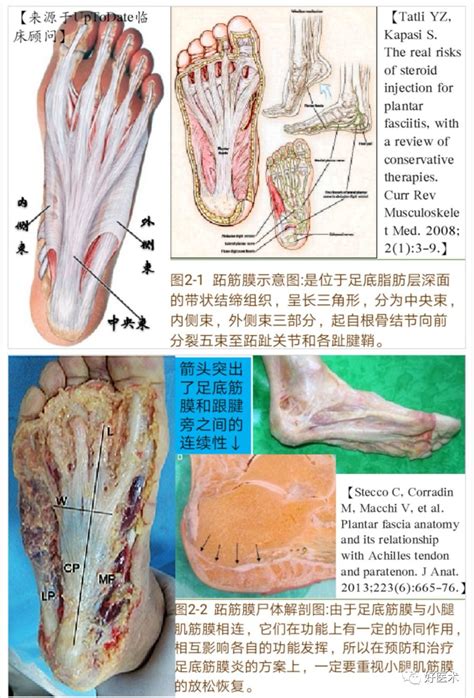 一文详解：足底跖筋膜炎的诊治策略 微医（挂号网）