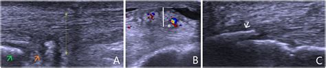 Ultrasonography And Doppler Guided Surgical Treatment For Insertional