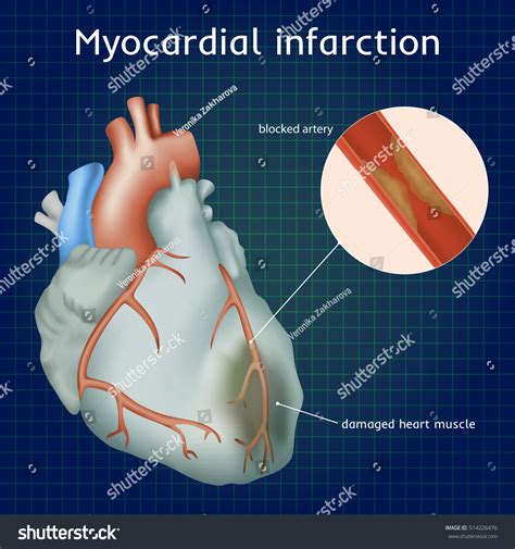 Myocardial Infarction Heart Attack Blocked Artery Stock Vector Royalty