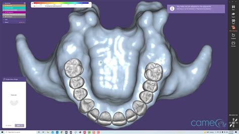 Creating An Full Arch Implant Denture On Exocad And Blue Sky Plan YouTube