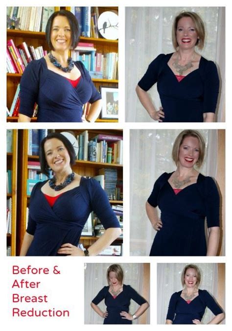 Breast Reduction Before And After In Clothes