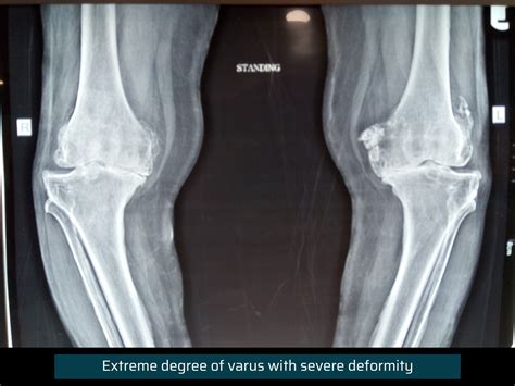 Complex Primary Total Knee Replacement Surgery Dr Rachit Sheth