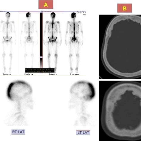 Bone Scan A Showing Foci Of Increased Activity In The Ribs Skull