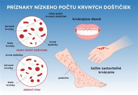 Petechie Červené tečky na kůži nepodceňujte mohou znamenat vážný