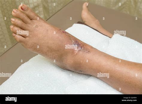 Infected Wound Stock Photos And Infected Wound Stock Images Alamy