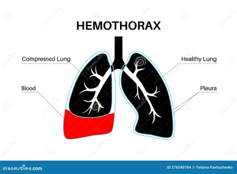 D Illustration Of Hemothorax Normal Lung Versus Collapsed Symptoms