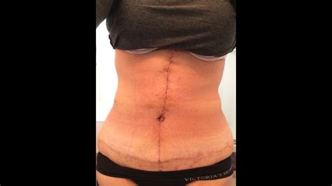 Tummy Tuck Revision 3 Weeks Youtube